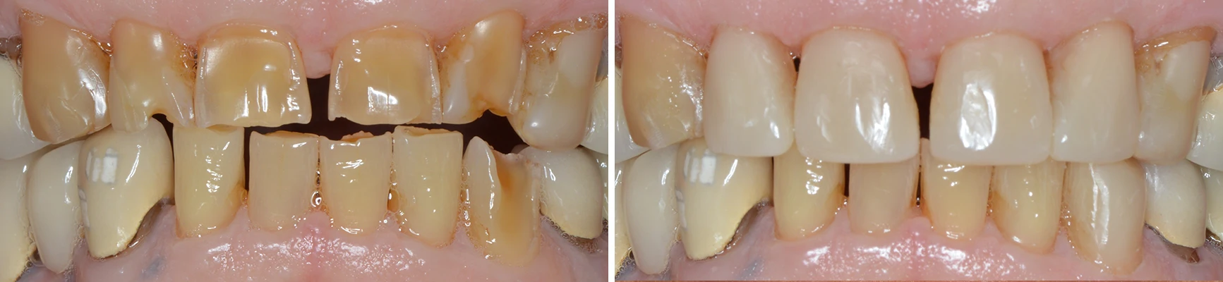 Dentist Waukesha WI Composite Veneers