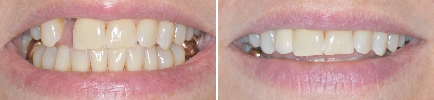 Dentist Waukesha WI Implant Before and After
