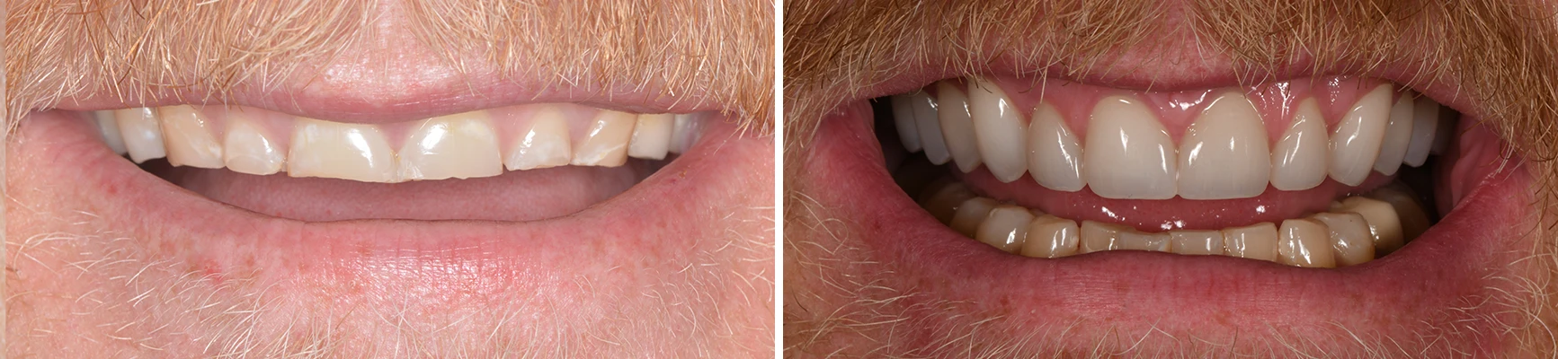 Dentist Waukesha WI Tooth Before and After Crowns